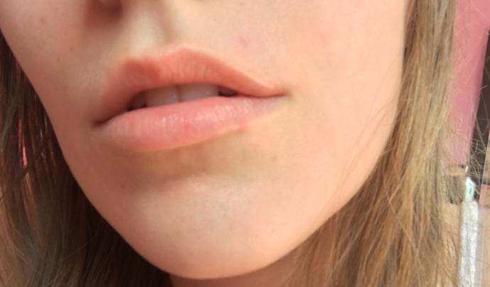 Cold sores, or pimples?