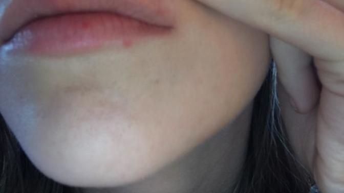Cold sores, or pimples?