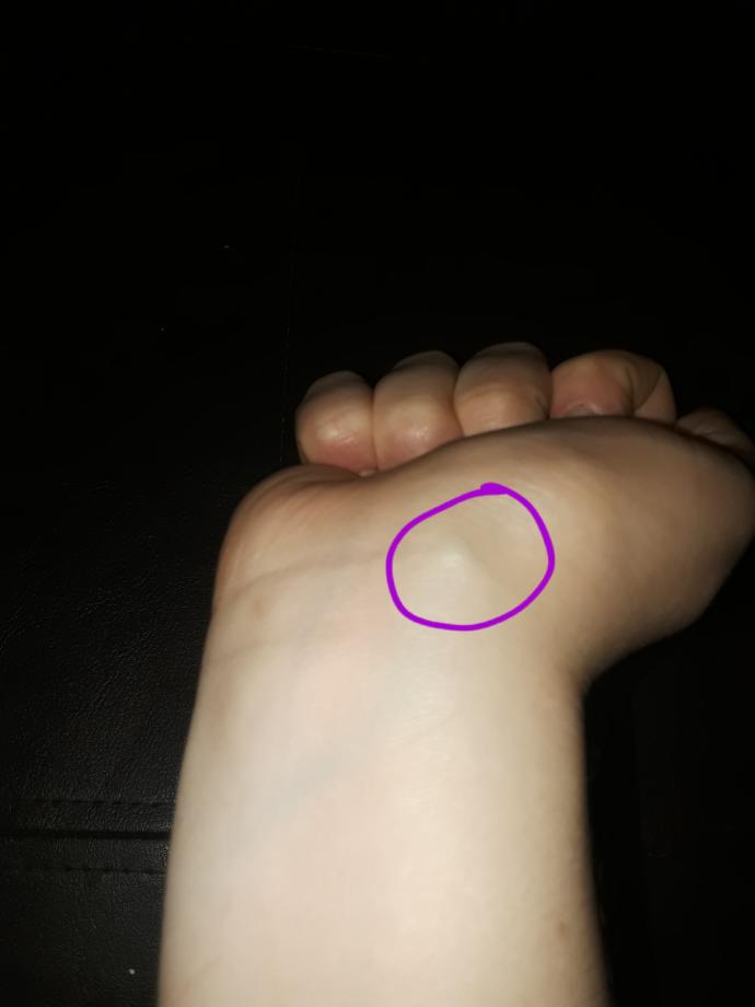 How long do ganglion cysts last?