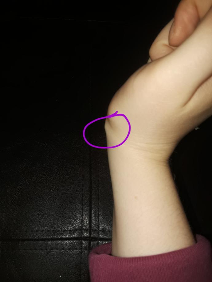 How long do ganglion cysts last?