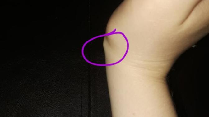 How long do ganglion cysts last?