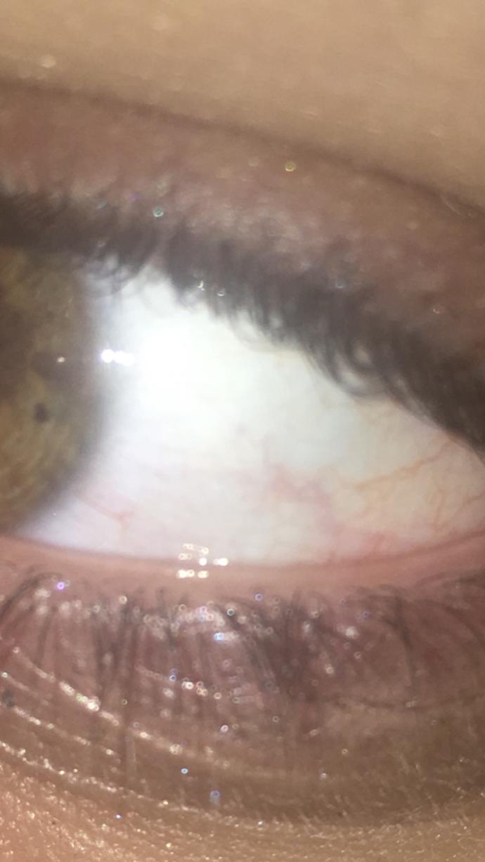 What do you know about Pinguecula? do you think my eye is okay?