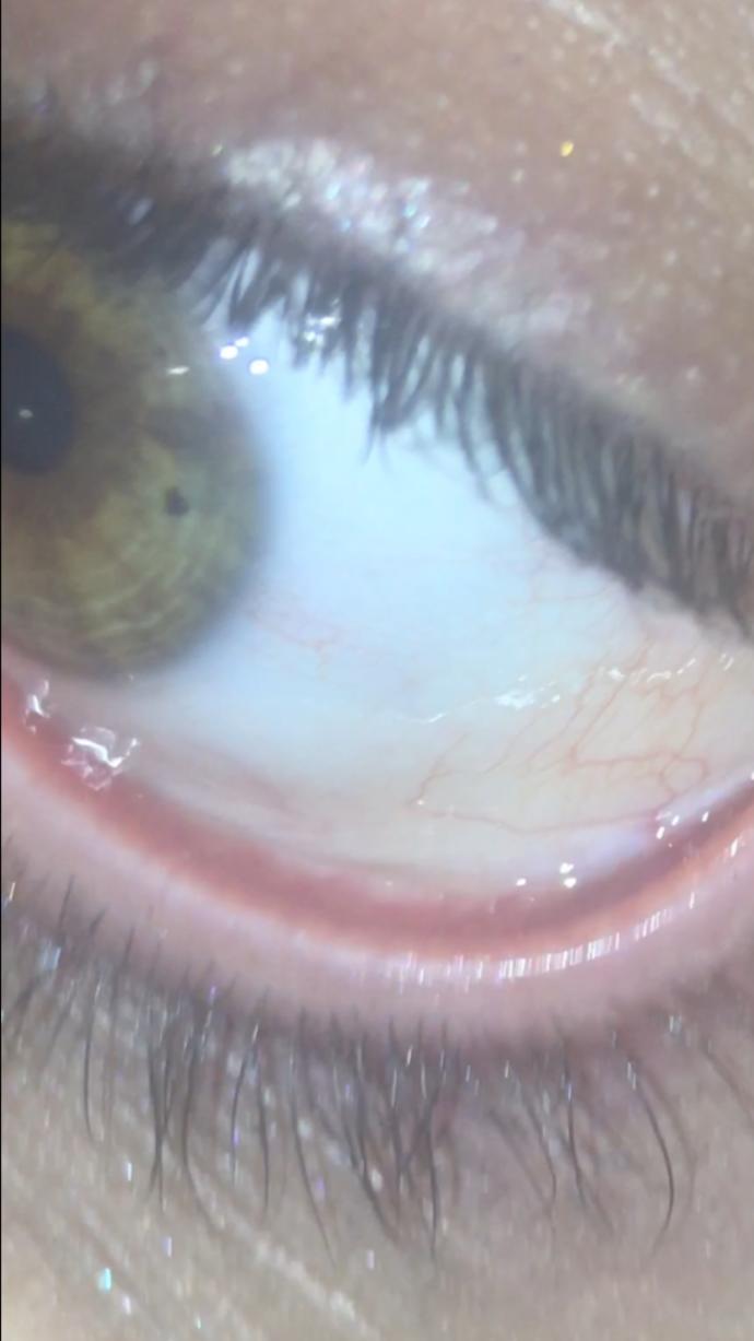 What do you know about Pinguecula? do you think my eye is okay?