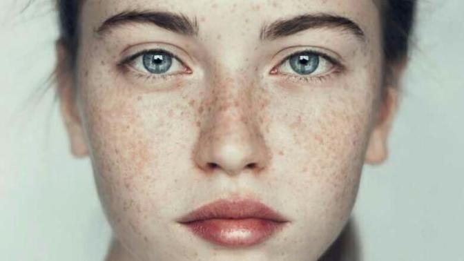 Freckles! Hot or Not?