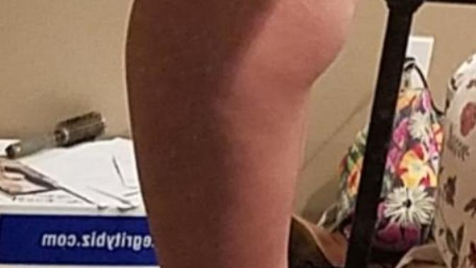 Recovering Anorexic - How Do I Look?