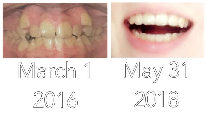 Have you ever had braces before?