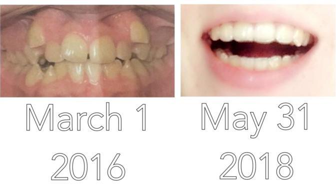 Have you ever had braces before?