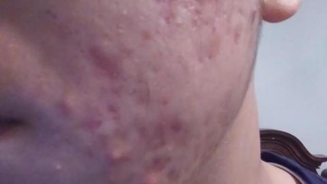 Accutane: Should I take it?