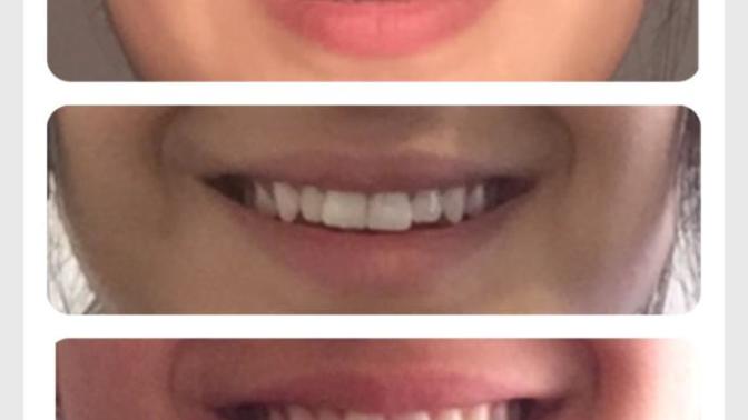Is one or a few crooked teeth a turn off for guys?