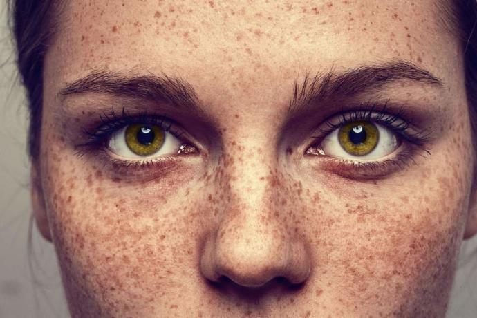 Why are freckles considered beautiful?