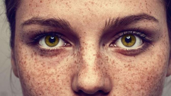 Why are freckles considered beautiful?