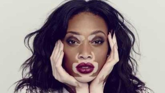 Thoughts on people with vitiligo?