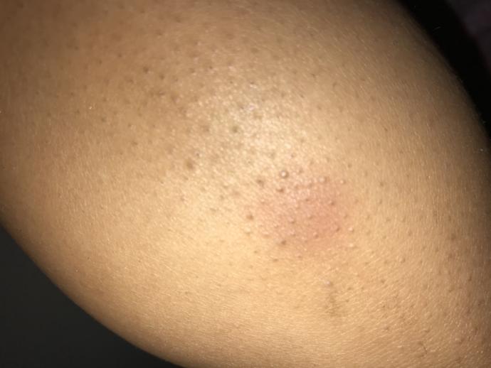 Guys , I’m freaking out !! what’s this red spot on my arm that won’t go away?
