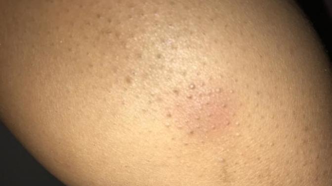Guys , I’m freaking out !! what’s this red spot on my arm that won’t go away?