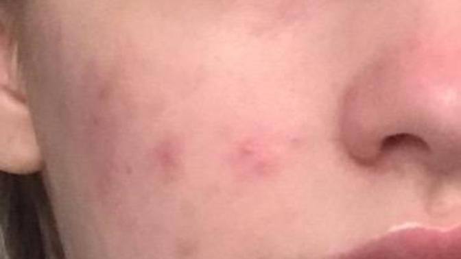 Guys, your opinion on bad skin?
