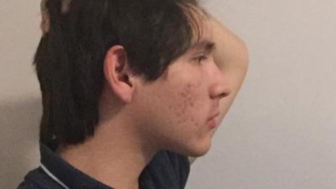 Girls, is my side profile ugly cause of my acne and nose?