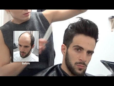 Guys with hair loss; would you consider hair plugs, a wig or a piece?