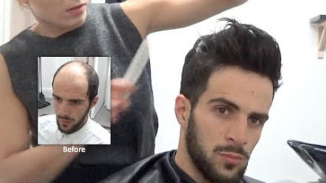 Guys with hair loss; would you consider hair plugs, a wig or a piece?