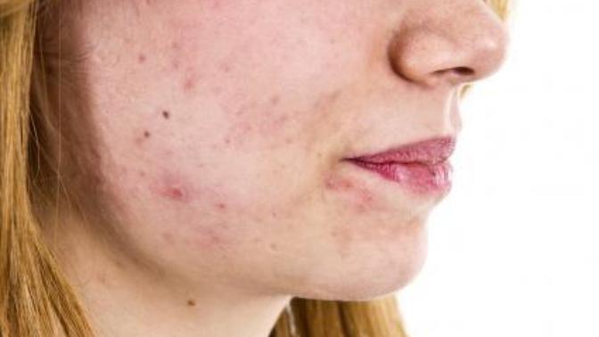 How can I cure my acne?