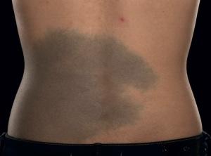 Are large birth marks a turn off?