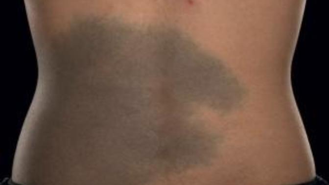Are large birth marks a turn off?