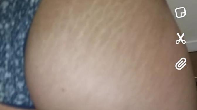 Are stretch marks a turn off?