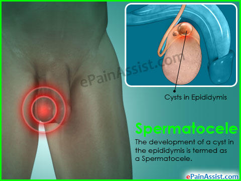 Do I have testicular cyst?