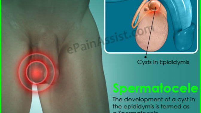Do I have testicular cyst?