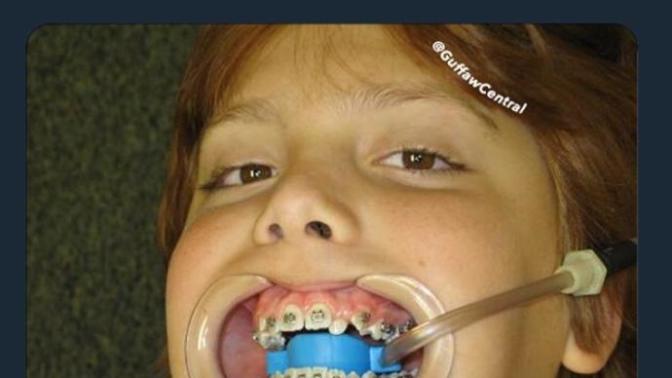 Have you ever had braces?