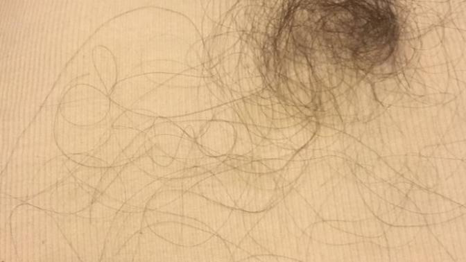 Suffering from hair loss- what shall I do?
