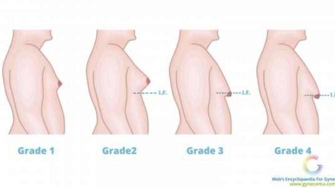 Girls, Would you date someone with gynecomastia?