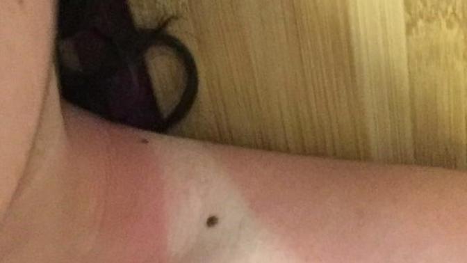 What’s the best way to get rid of a sunburn?