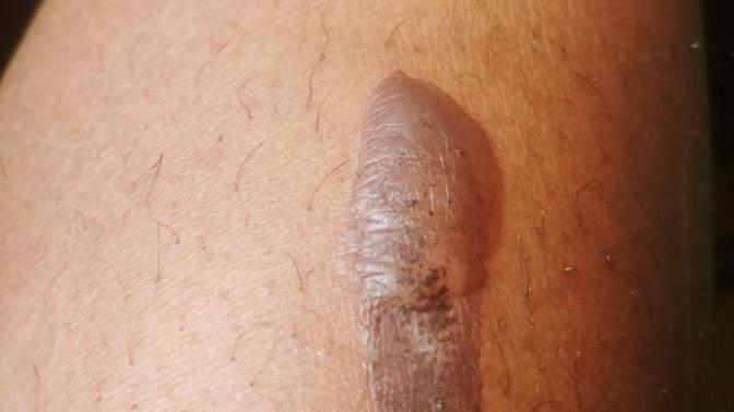 Ways to lighten / make this burn scar fade?
