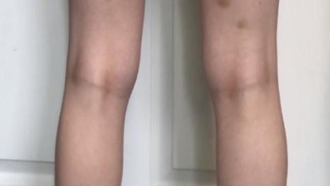 Did I tear my hamstrings (image provided)?