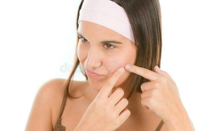 Dealing with acne 😢?