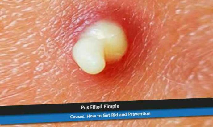 Dealing with acne 😢?
