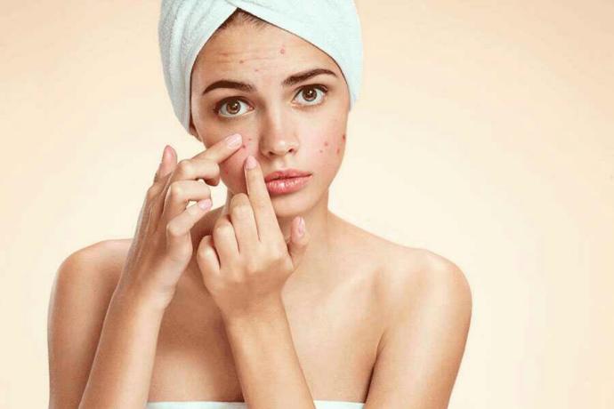 Dealing with acne 😢?