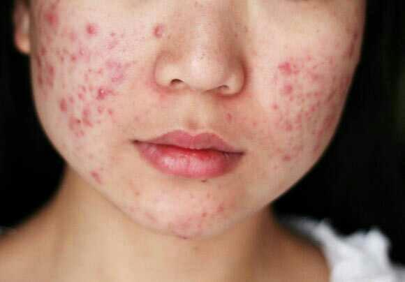 Dealing with acne 😢?