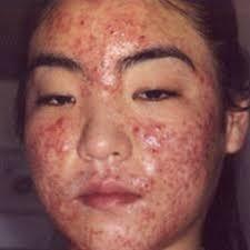 What do you think when you see someone with cystic acne?