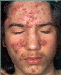 What do you think when you see someone with cystic acne?