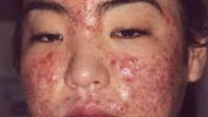 What do you think when you see someone with cystic acne?