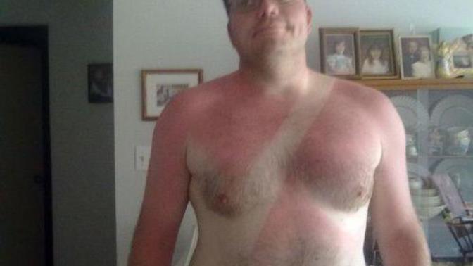 Have you ever gotten a sunburn from simply driving in a car?