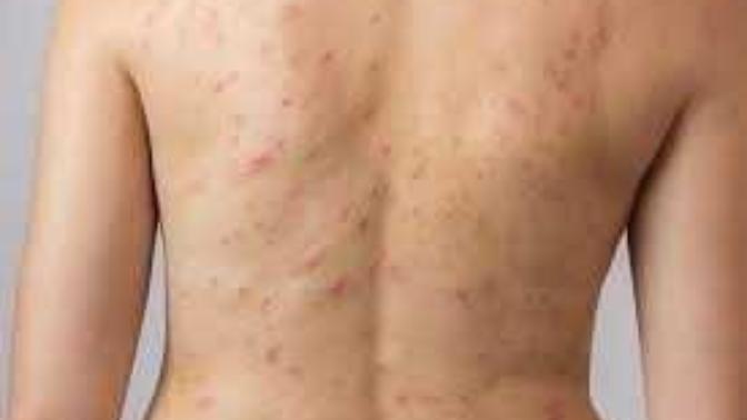 Have you ever had to deal with troublesome back/shoulder acne?