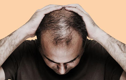 What would you do if you started balding?