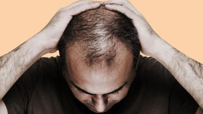 What would you do if you started balding?