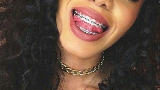 Guys, Are Braces Unattractive?