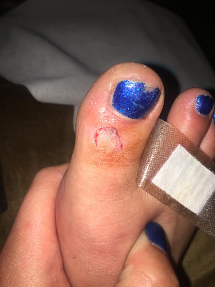 Do I need stitches?