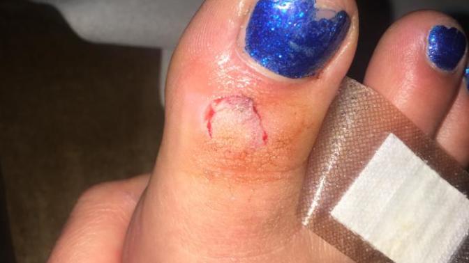 Do I need stitches?