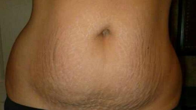 What do you think about Postpartum bellies?