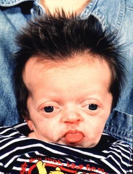Why do families choose to keep kids who are severely deformed instead of absorption?